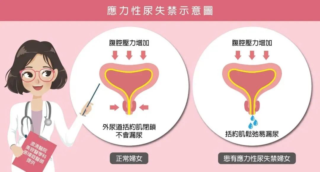 盆底康复