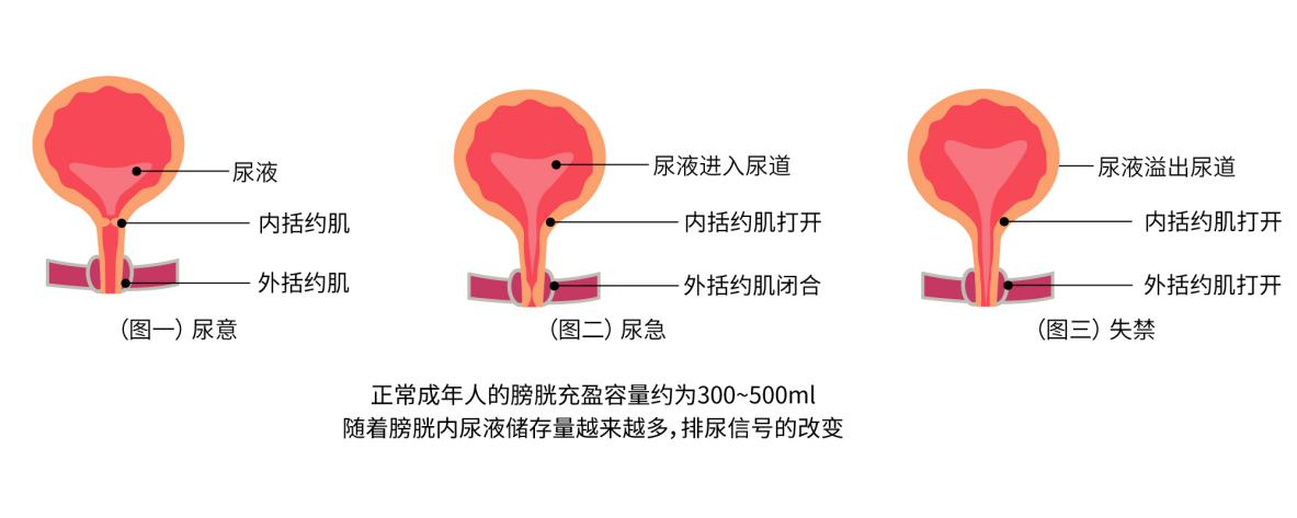 漏尿治疗