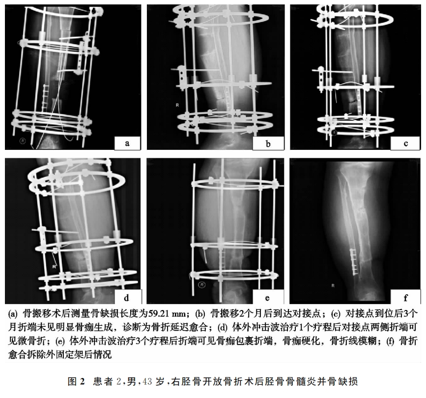 骨搬移术后对接端不愈合的治疗新手段