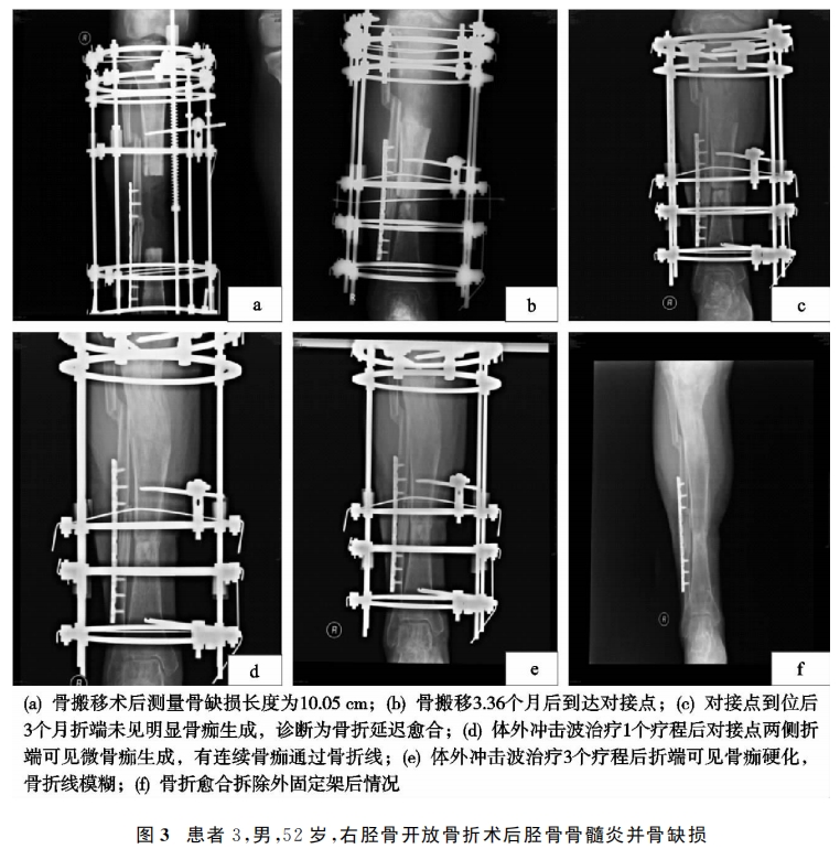 骨搬移术后对接端不愈合的治疗新手段